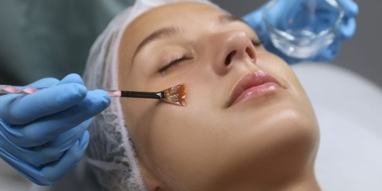 How Chemical Peels Can Revive Your Skin in Woodbury